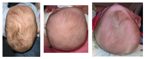 Spotting the Signs of Craniosynostosis in Babies